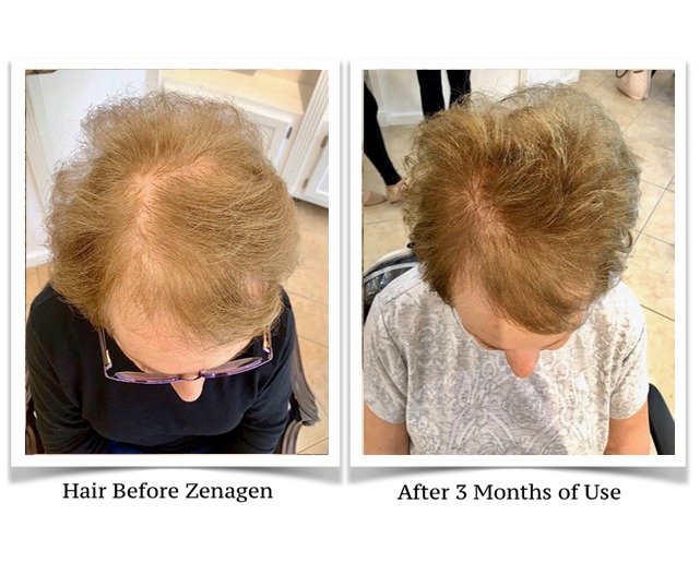 Zenagen shampoo deals